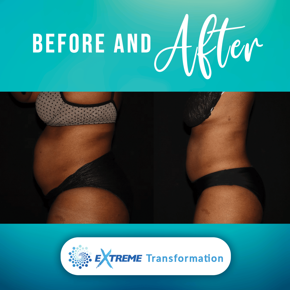 Body Contouring Orlando Options. What Is Body Contouring, And How It Work?