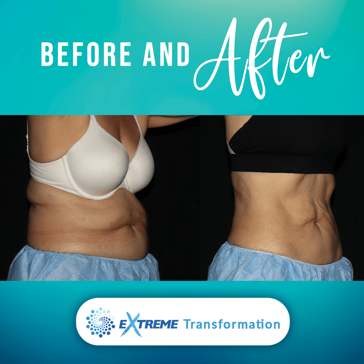 Body Contouring Orlando Options. What Is Body Contouring, And How It Work?