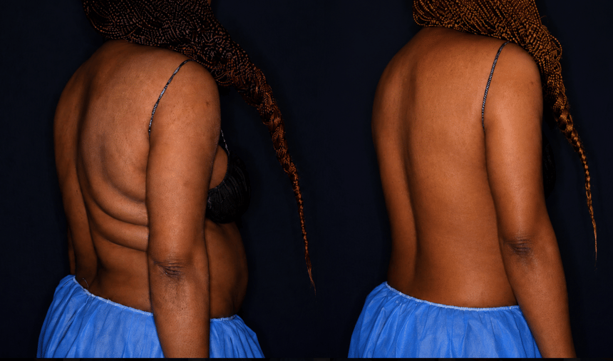 Bodenvy clinical before and after — client 05