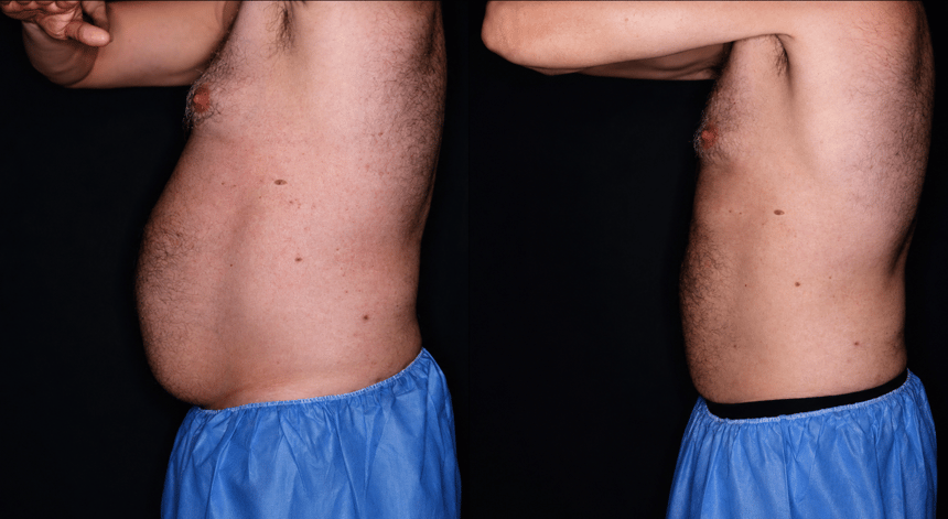 Bodenvy clinical before and after — client 04