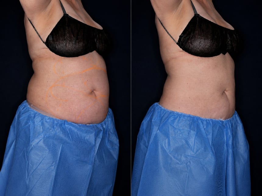 Bodenvy clinical before and after — client 09