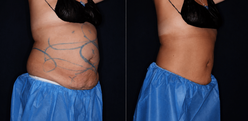 Bodenvy clinical before and after — client 07