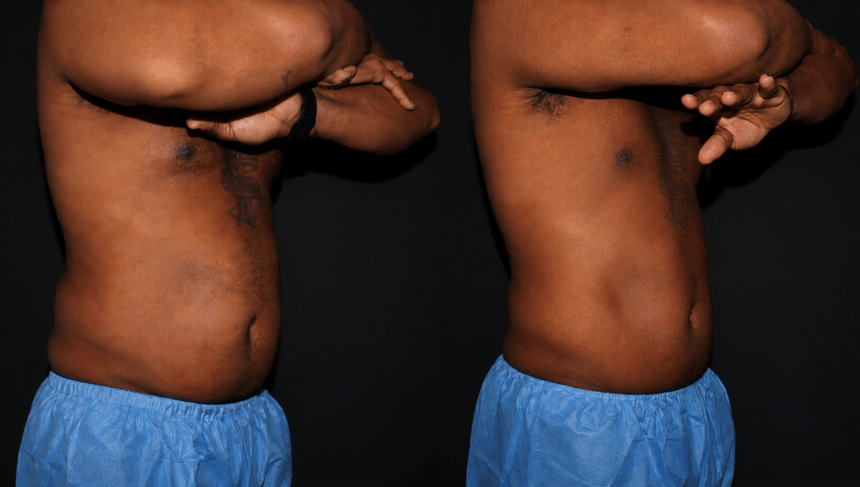 Bodenvy clinical before and after — client 06