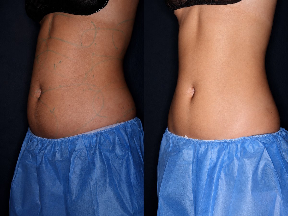 Before and after — abdomen