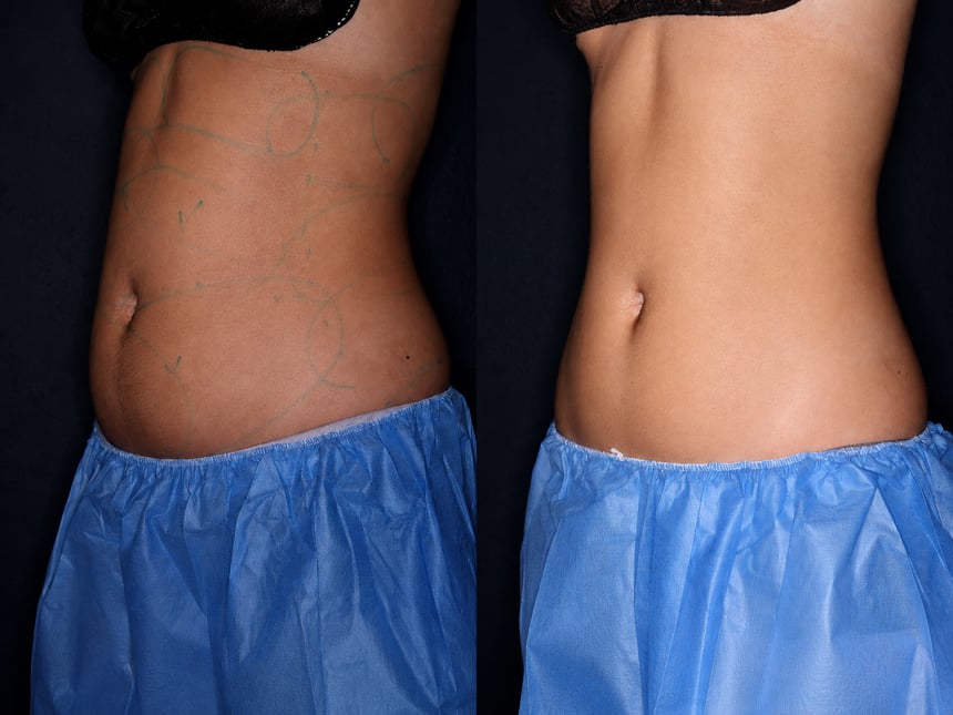 Bodenvy CoolSculpting before and after — abdomen