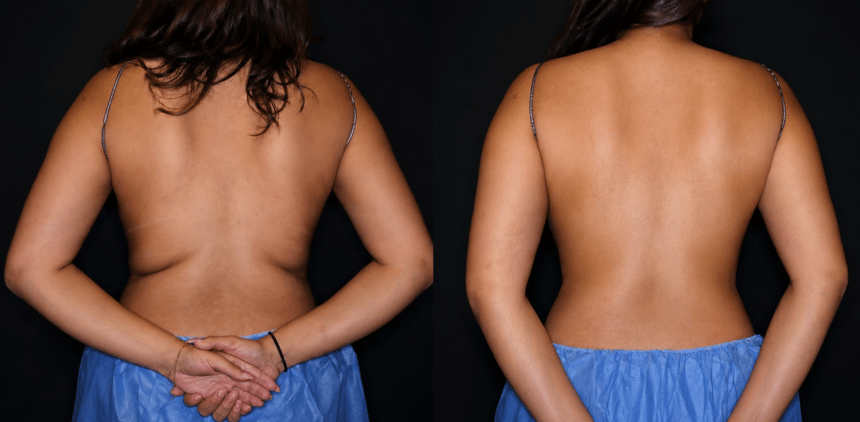 Bodenvy clinical before and after — client 02