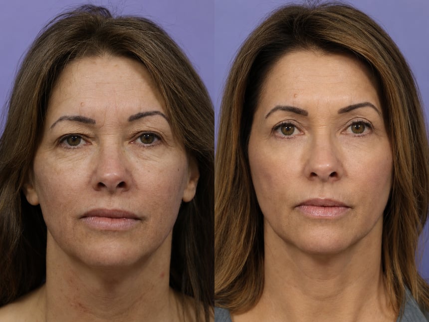 Texture and tone before and after