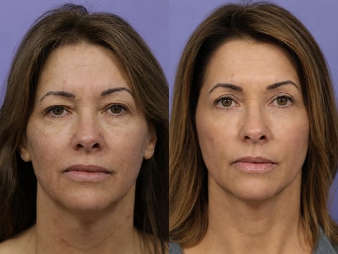 Bodenvy client before and after skin tightening: Texture and Tone
