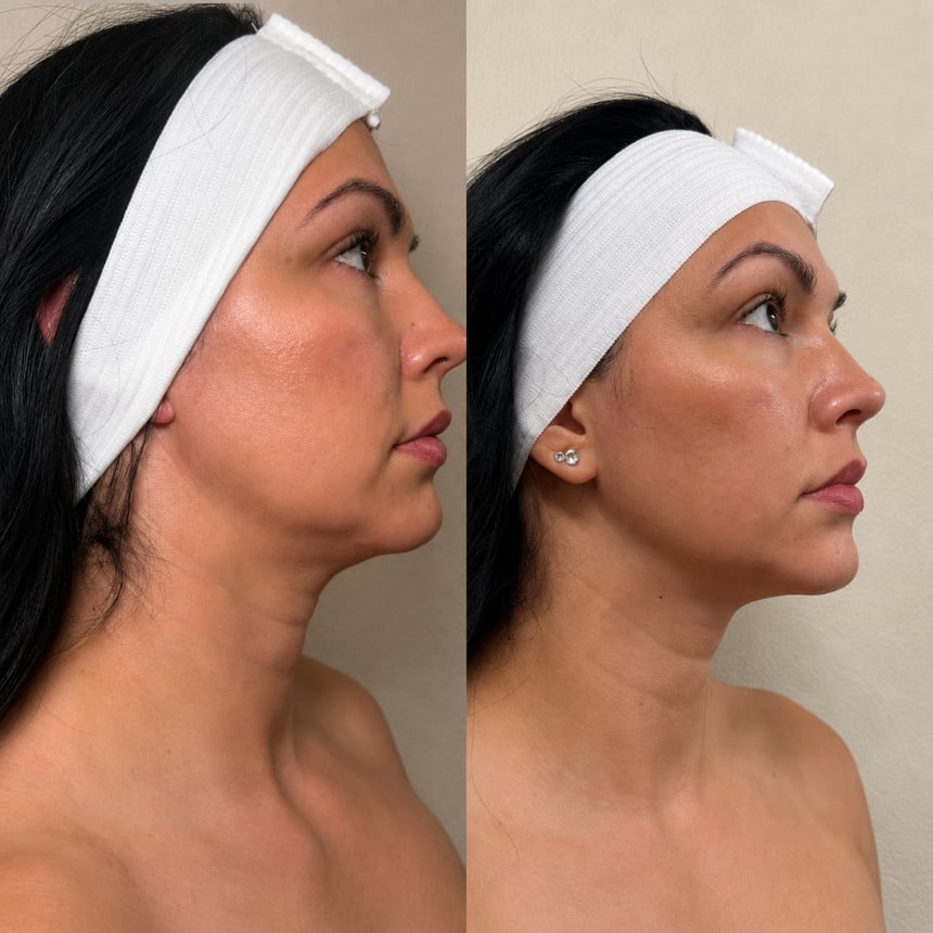 Skin tightening before and after