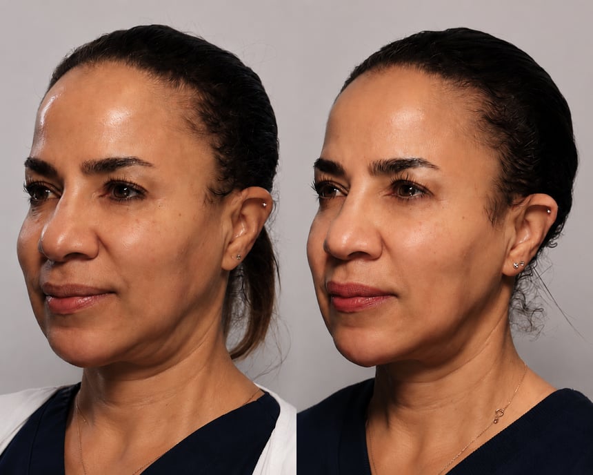 Skin renewal before and after