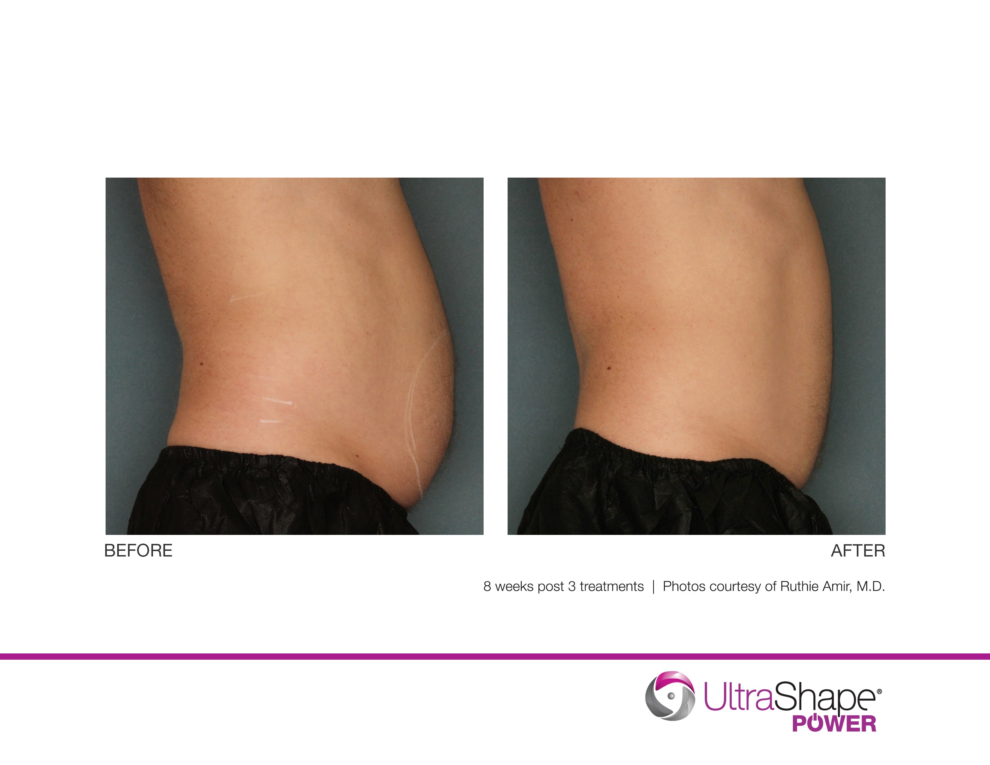 Laser Fat Removal Orlando