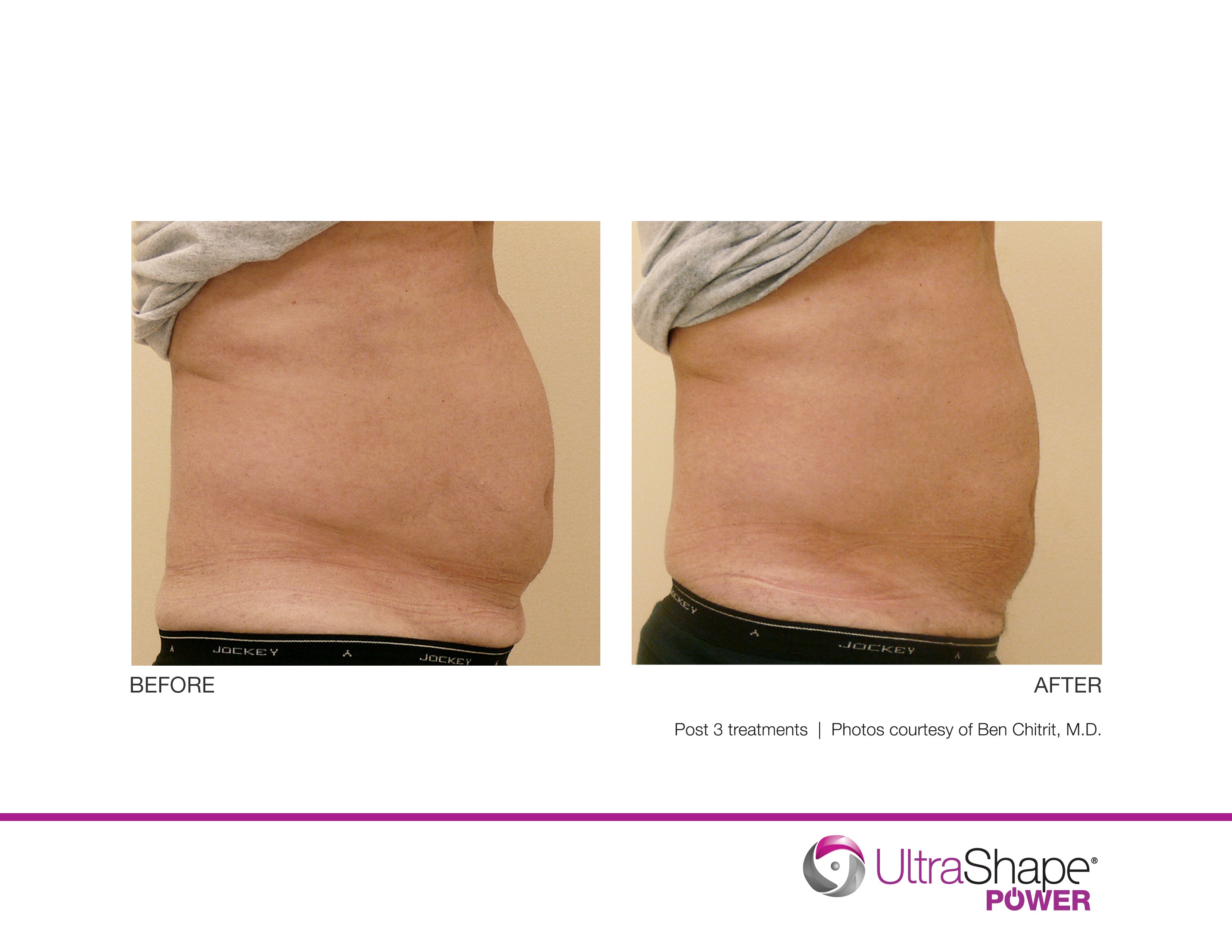 Laser Fat Removal Orlando