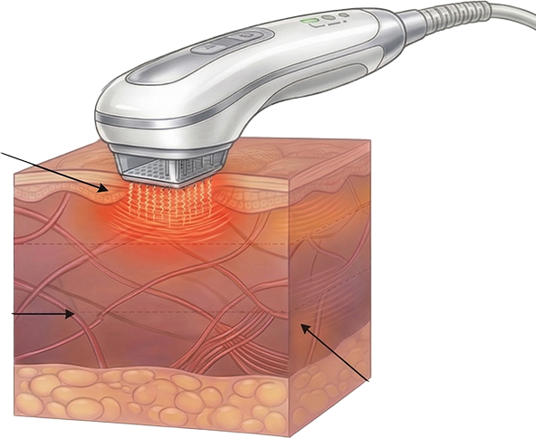 Upper dermis treatment