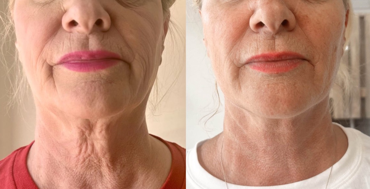Bodenvy client before and after skin tightening: Neck and Jawline