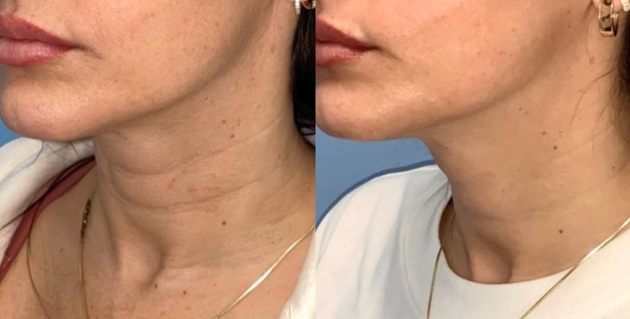 Bodenvy client before and after skin tightening: Smile Lines