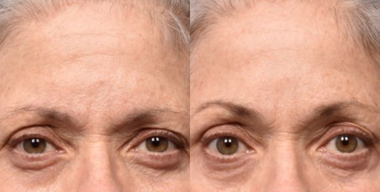 Bodenvy client before and after skin tightening: Neck Tightening