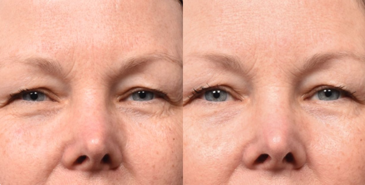 Bodenvy client before and after skin tightening: Facial Texture