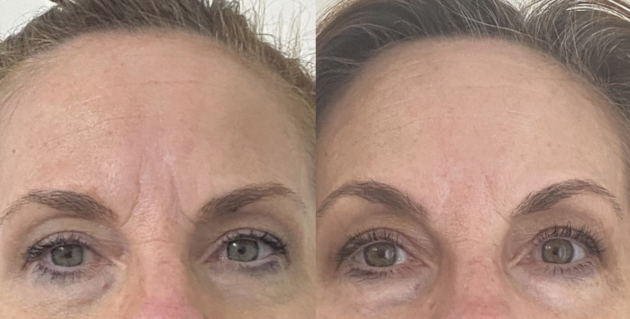 Bodenvy client before and after skin tightening: Skin Renewal