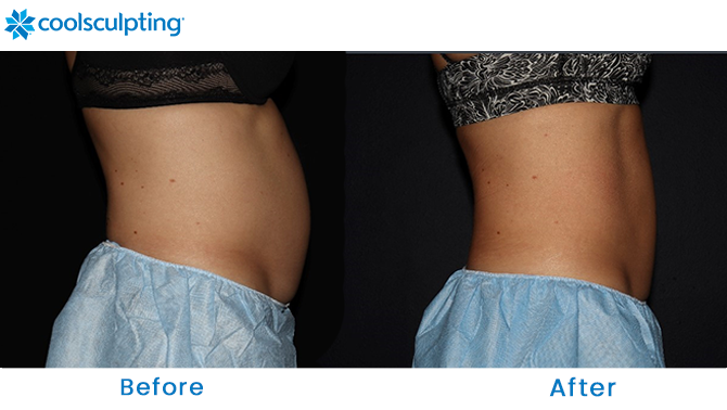 Before and After CoolSculpting Stomach in Dr. Phillips  