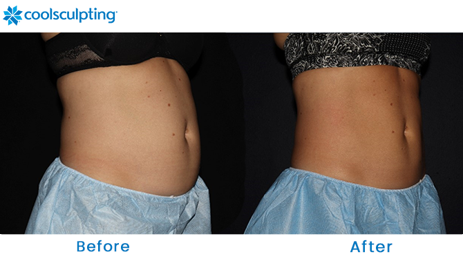 Before and After CoolSculpting Stomach Orlando Florida