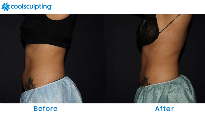 Before and After CoolSculpting Stomach in Dr. Phillips, FL