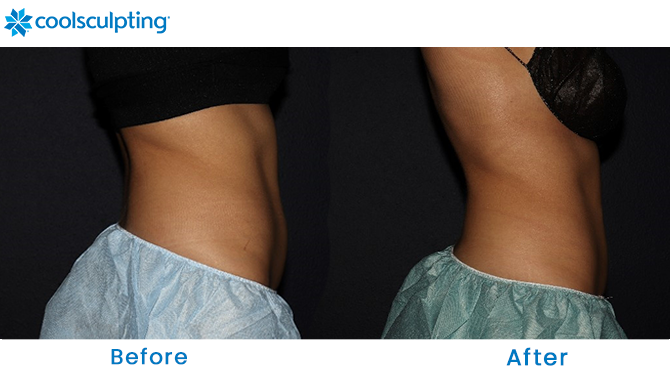 CoolSculpting Before and After Stomach Florida