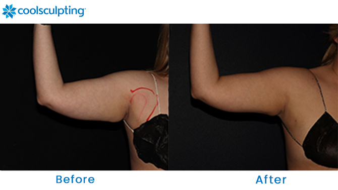 CoolSculpting for Arms Before and After Winter Park