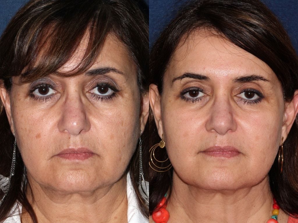 Bodenvy real client before and after 5-Step Renewal skin tightening — entire face tightening with no needles