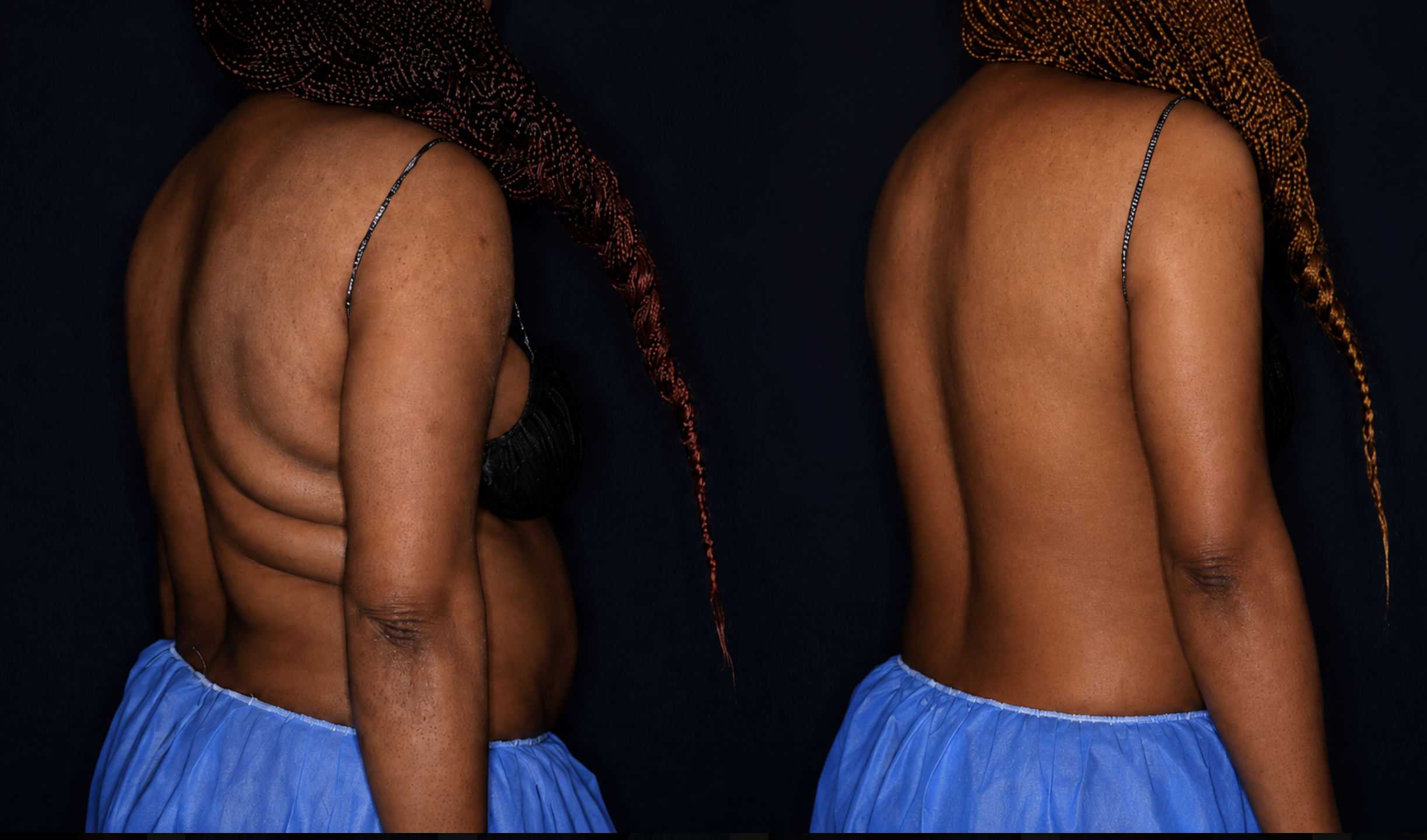 CoolSculpting before after
