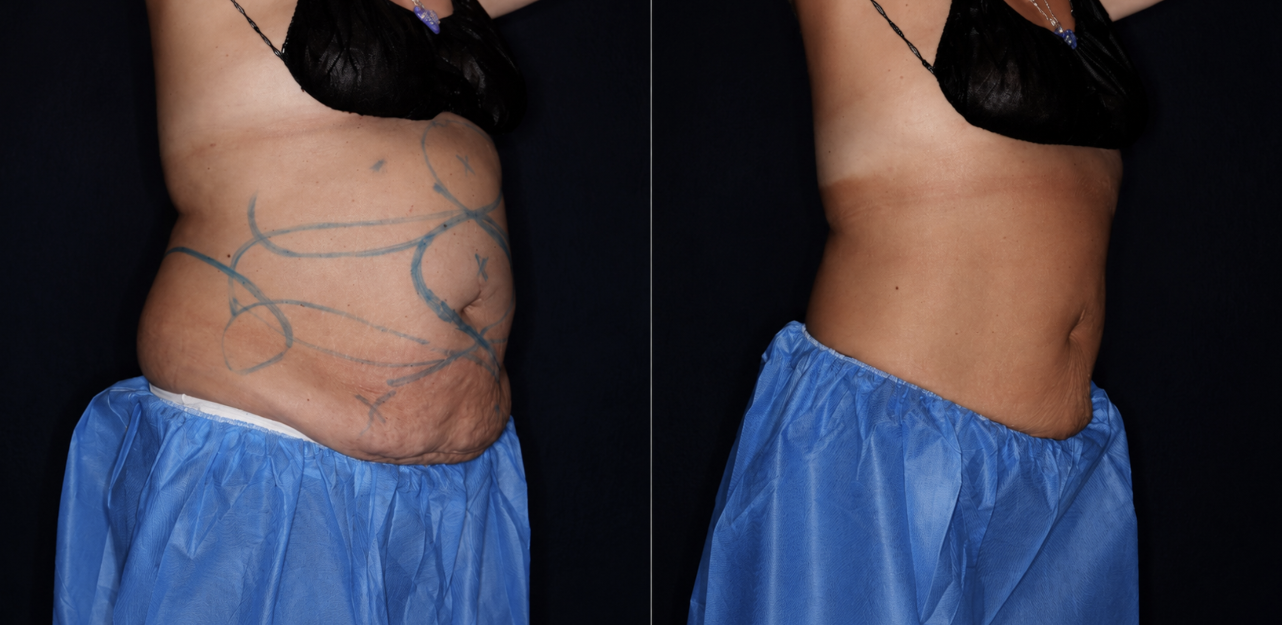 CoolSculpting before after