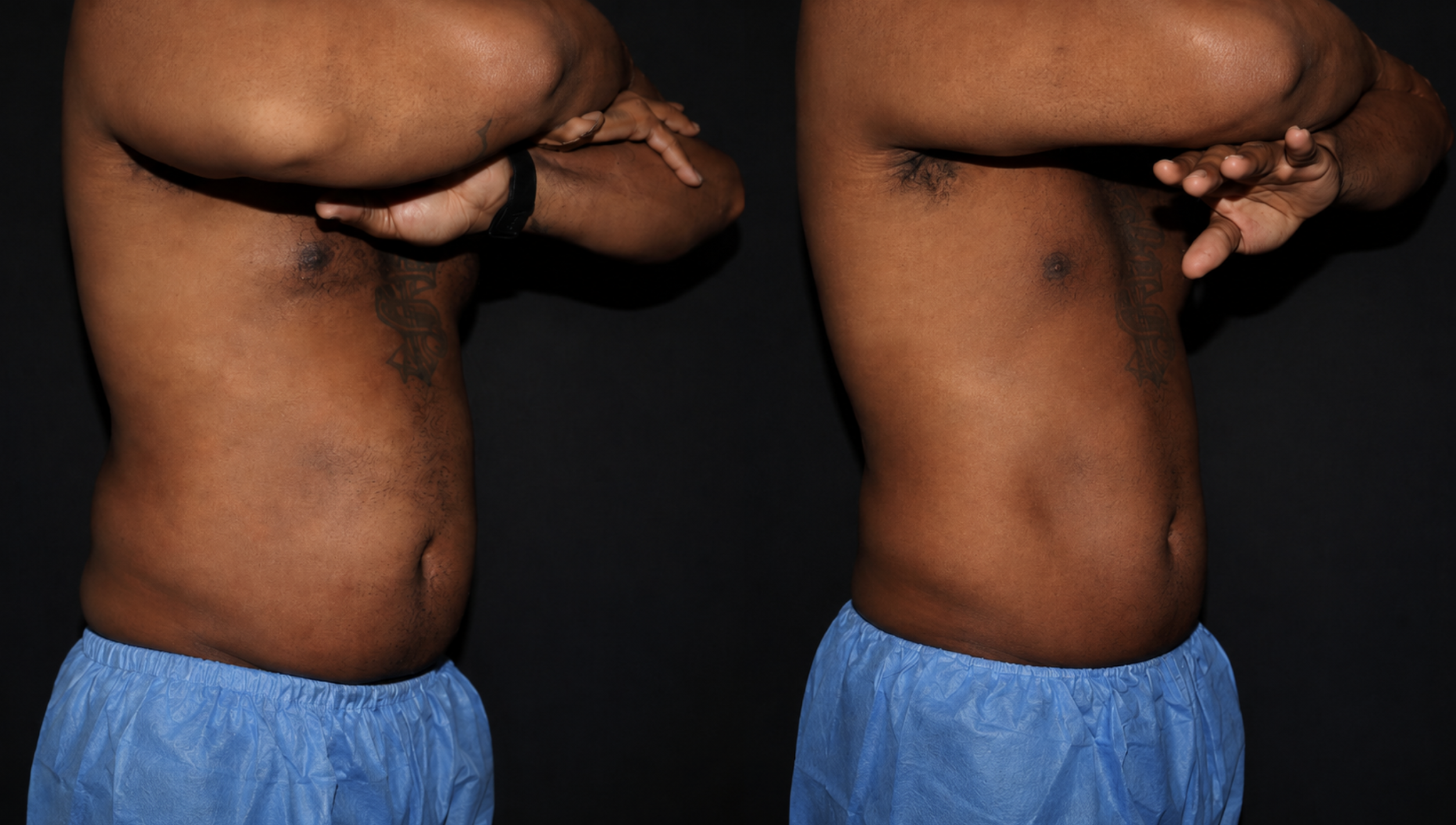 CoolSculpting before after