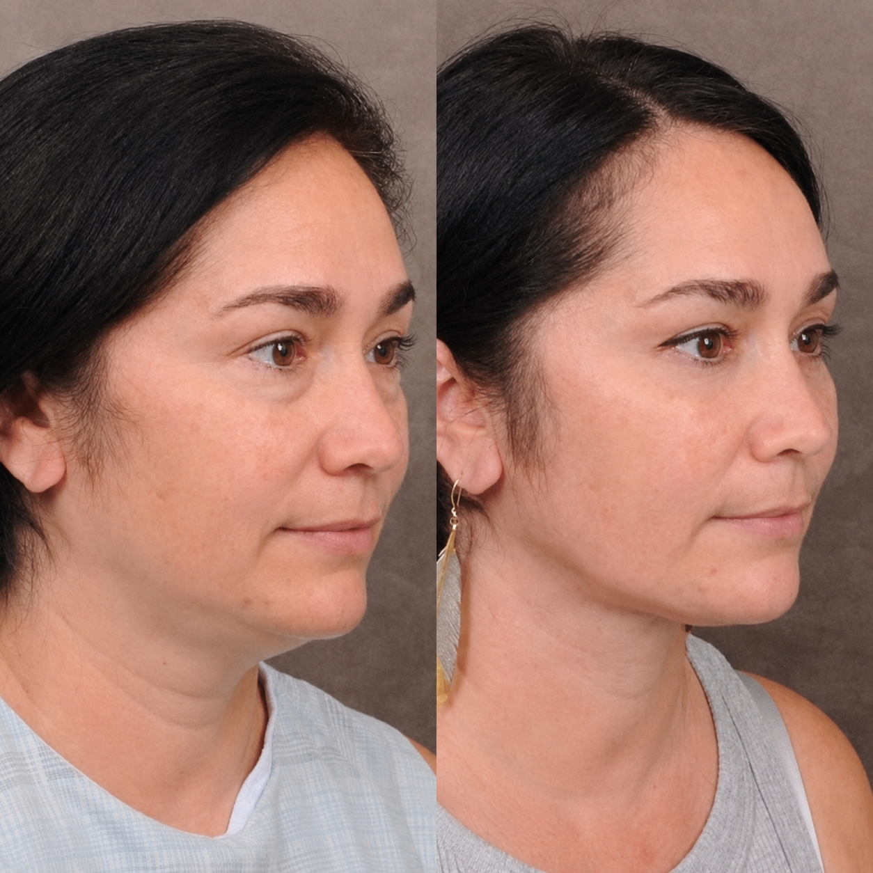 Bodenvy real client before and after 5-Step Renewal skin tightening — firmer, smoother neck and décolletage