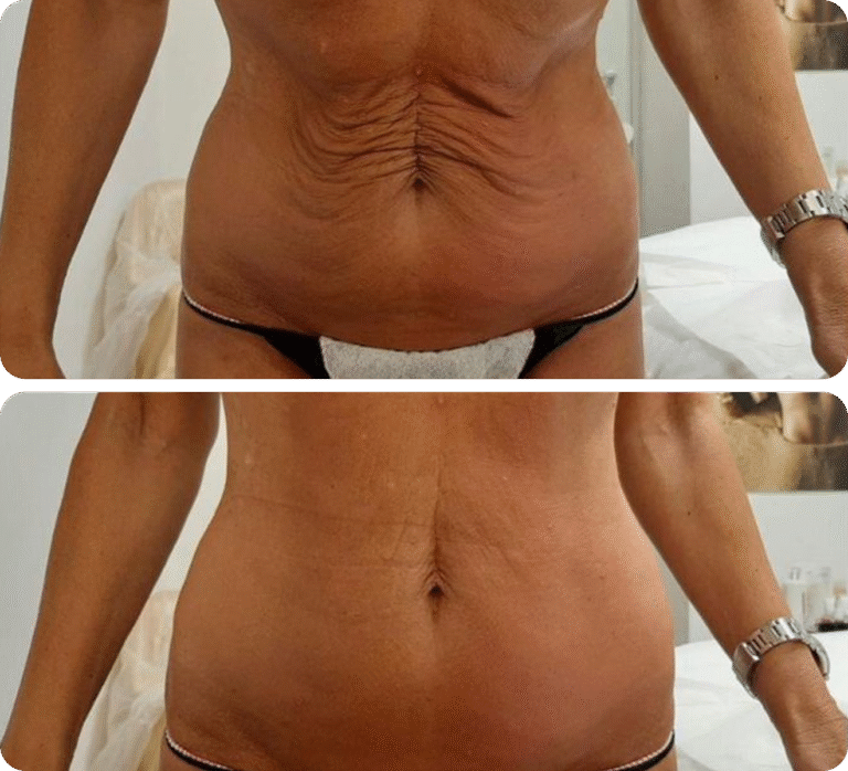 Bodenvy real client before and after 5-Step Renewal skin tightening — firmer, smoother belly skin after weight loss