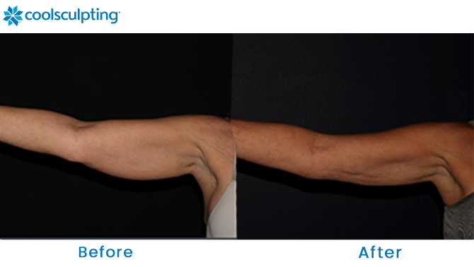 CoolSculpting for Arms Before and After Dr. Phillips
