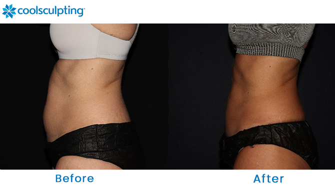 CoolSculpting Before and After Stomach in Dr. Phillips