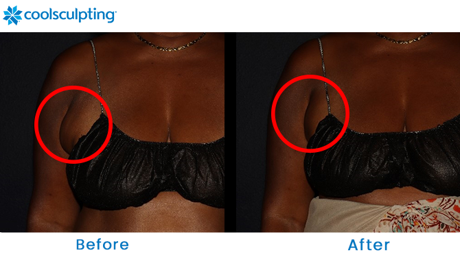 CoolSculpting Bra Fat in Winter Park FL