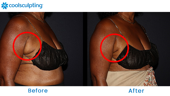 Coolsculpting Before and After Pictures - Female Bra Fat/Back