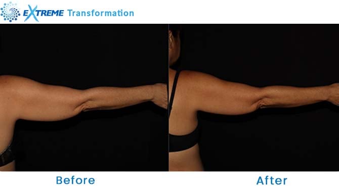 coolsculpting for arms before and after Winter Park Orlando