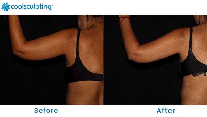 coolsculpting for arms before and after Dr. Philips FL