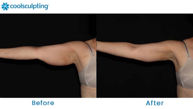 coolsculpting for arms before and after Orlando FL