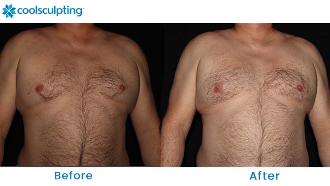 CoolSculpting male chest near me