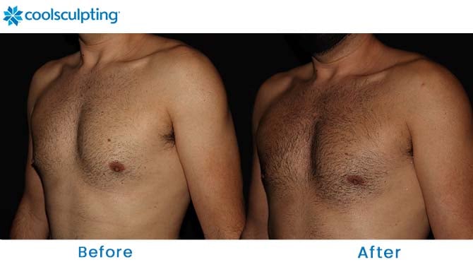 Coolsculpting chest orlando 