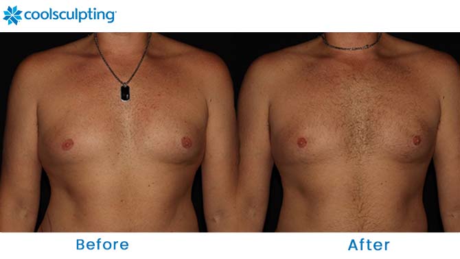 CoolSculpting male chest orlando