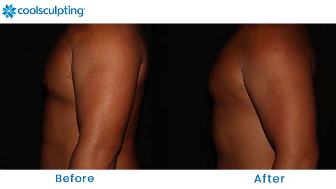 CoolSculpting male chest Orlando fl