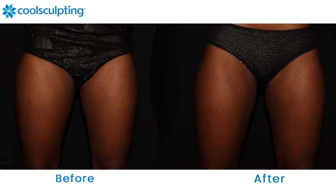 CoolSculpting thighs before and after orlando fl