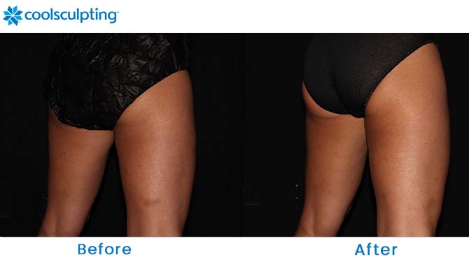 CoolSculpting thighs before and after dr. phillips orlando