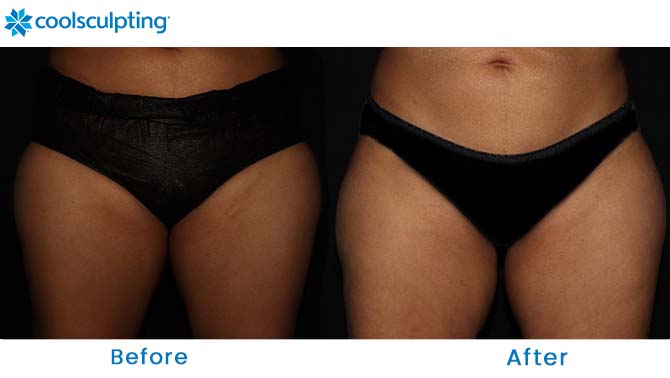 CoolSculpting thighs before and after orlando