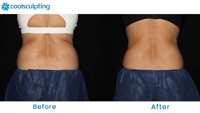 coolsculpting bra fat dr. phillips fl