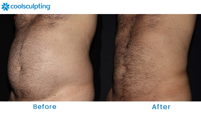 CoolSculpting Male Stomach Florida