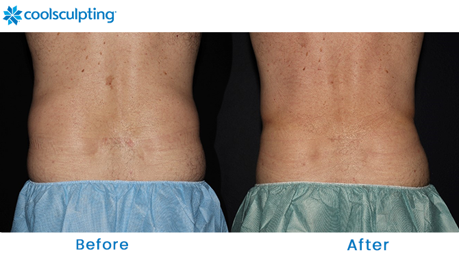 CoolSculpting Before and After Love Handles Winter Park, FL